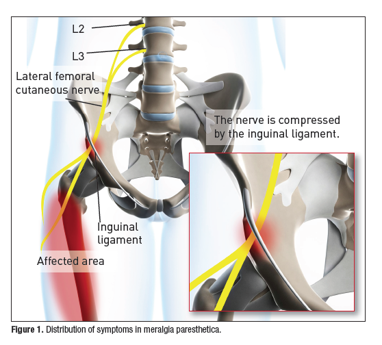 Accurate Education Meralgia Paresthetica Accurate Education Meralgia Paresthetica