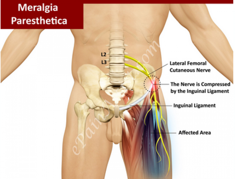 meralgia-paresthetica-a-common-cause-of-thigh-pain