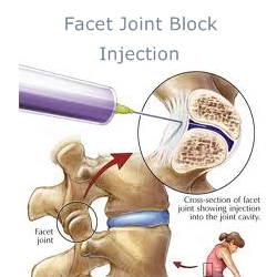 cervical facet joint nerve injection