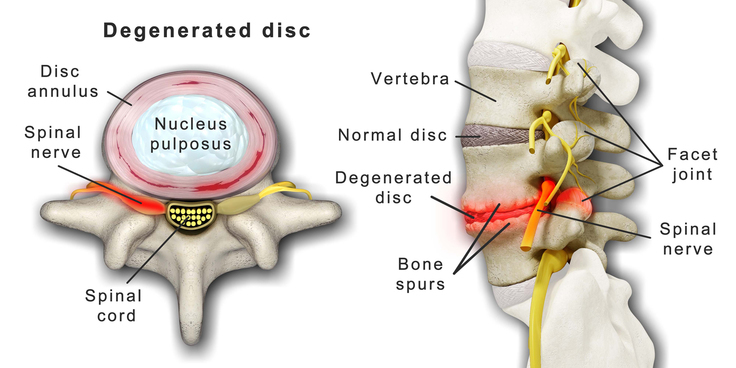 large_spine_degenerative_disc_disease_01
