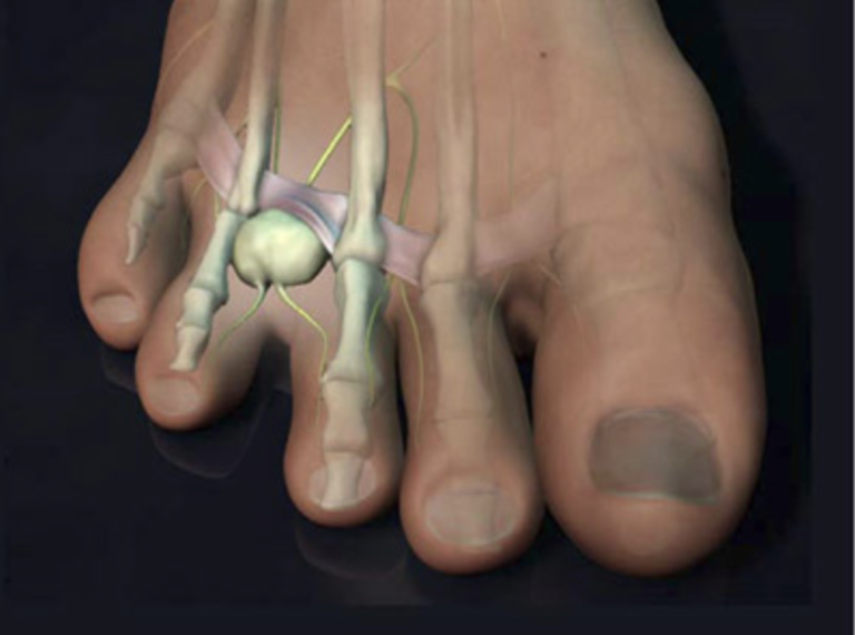 Accurate Education Mortons Neuroma Accurate Clinic