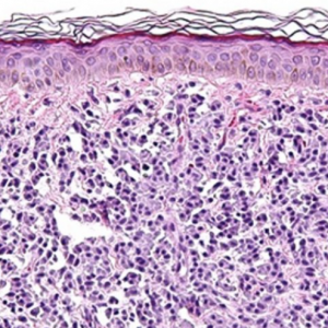 Accurate Education – Mast Cell Activation Disease (MCAD)